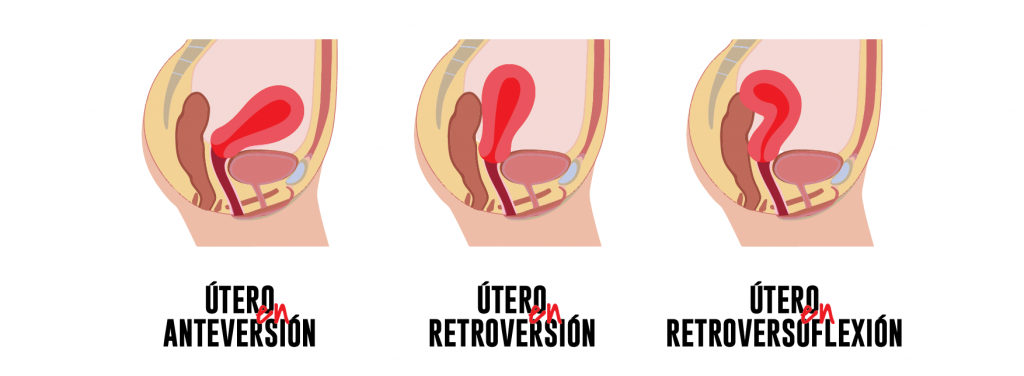 Diferencias utero retroverso